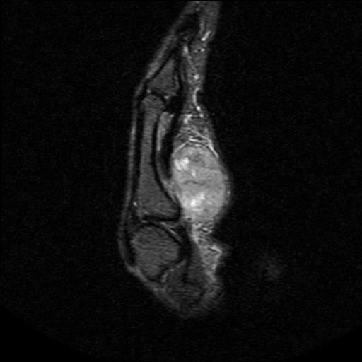 Sarcoma Hand0001